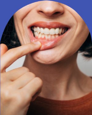 Bleeding Gums - Bell Family Dental in Bayside, NY Bleeding Gums - Bell Family Dental in Bayside, NY