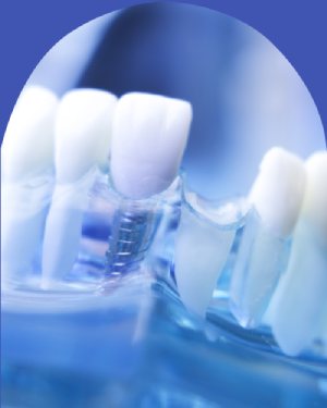 Missing Teeth - Bell Family Dental in Bayside, NY Missing Teeth - Bell Family Dental in Bayside, NY